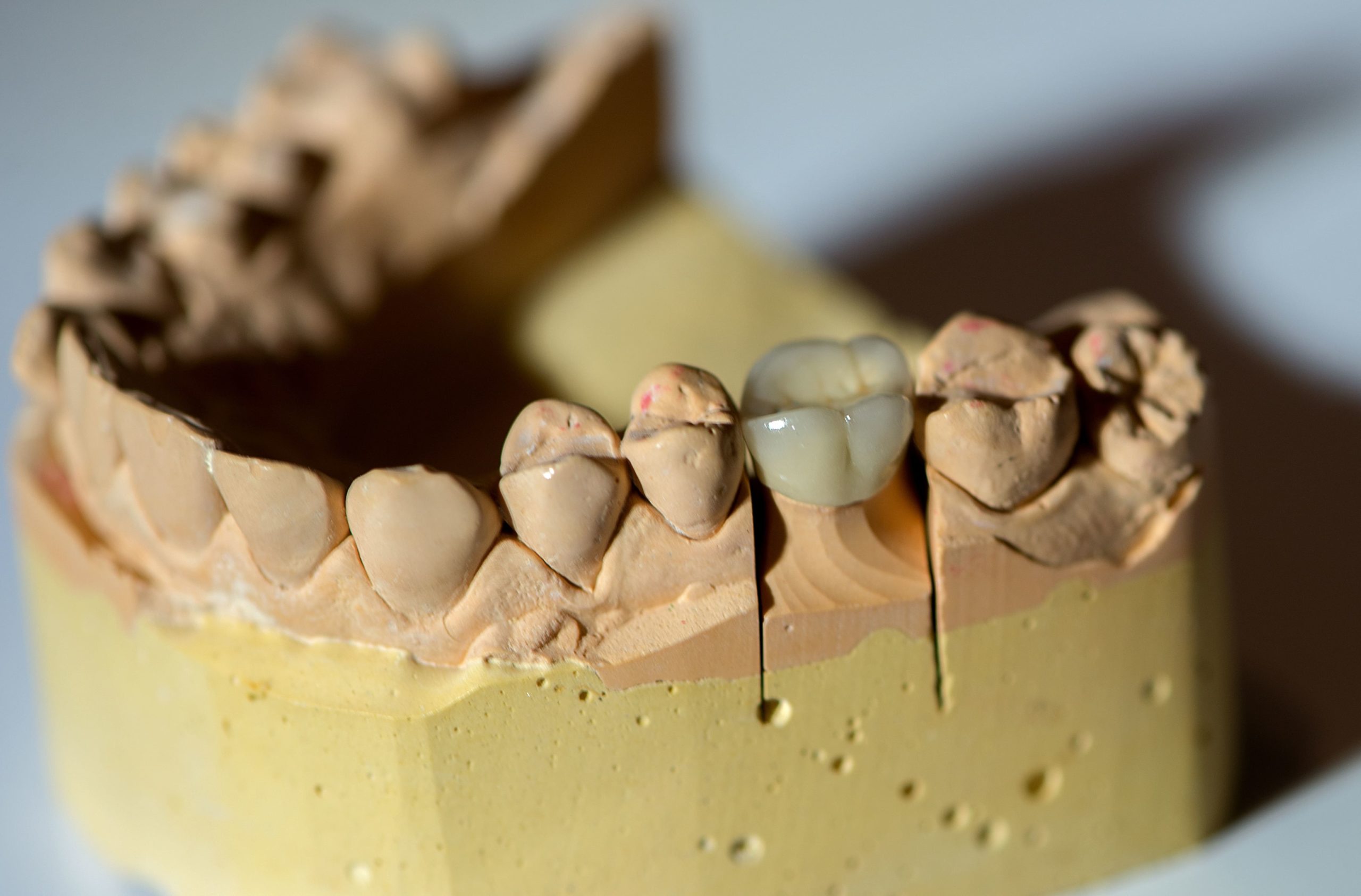 Crown dental
