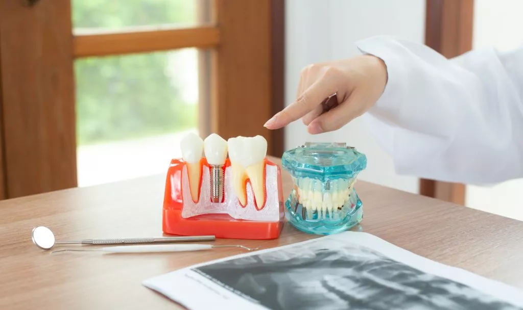 Dental implants