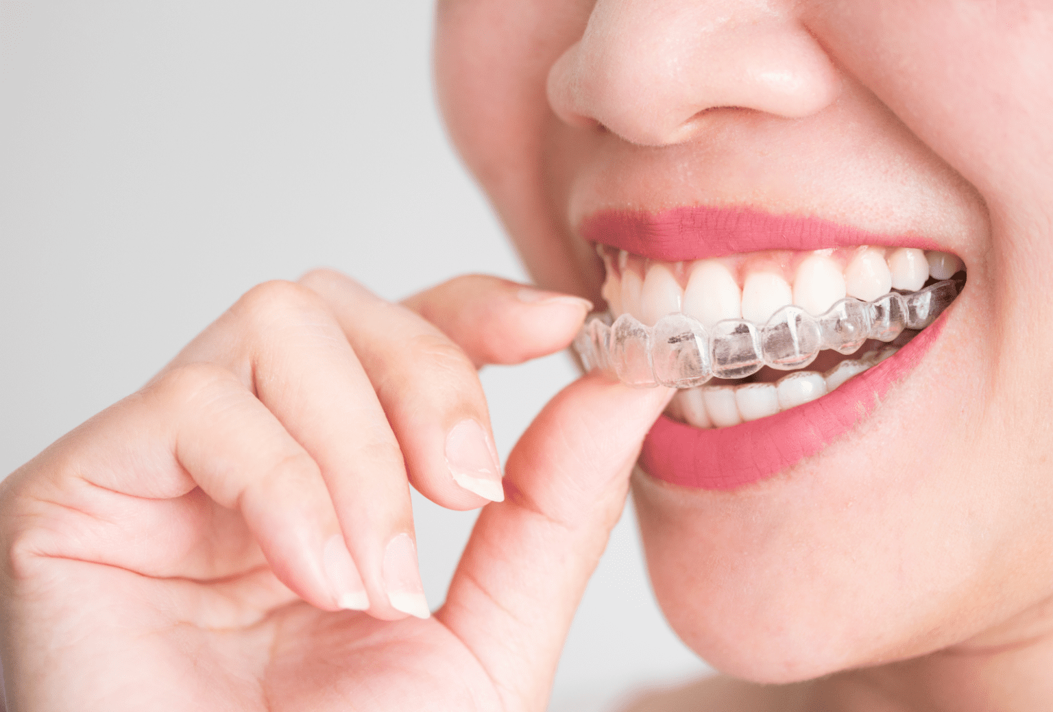 Trusted Quality Invisalign Aligners Channel Islands
