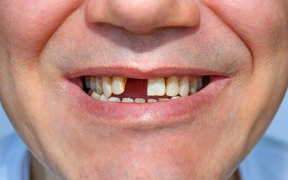 men smile without tooth