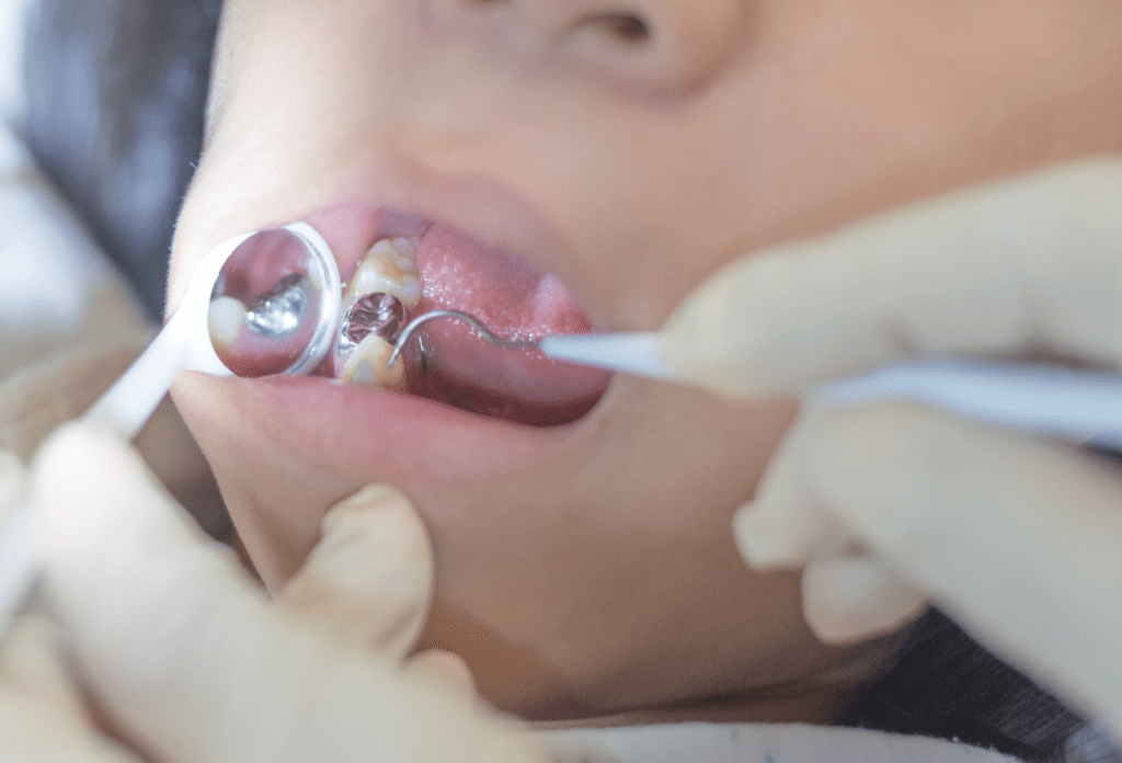 Dental Fillings - Rellenos Dentales