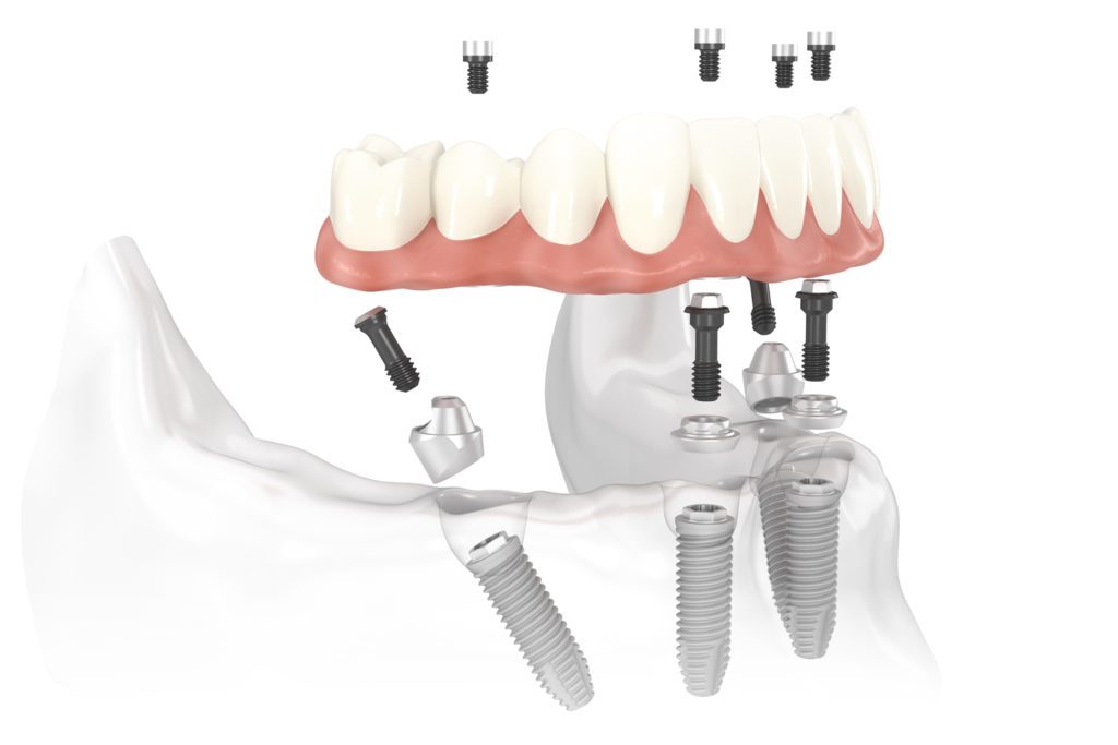implant dentistry procedure