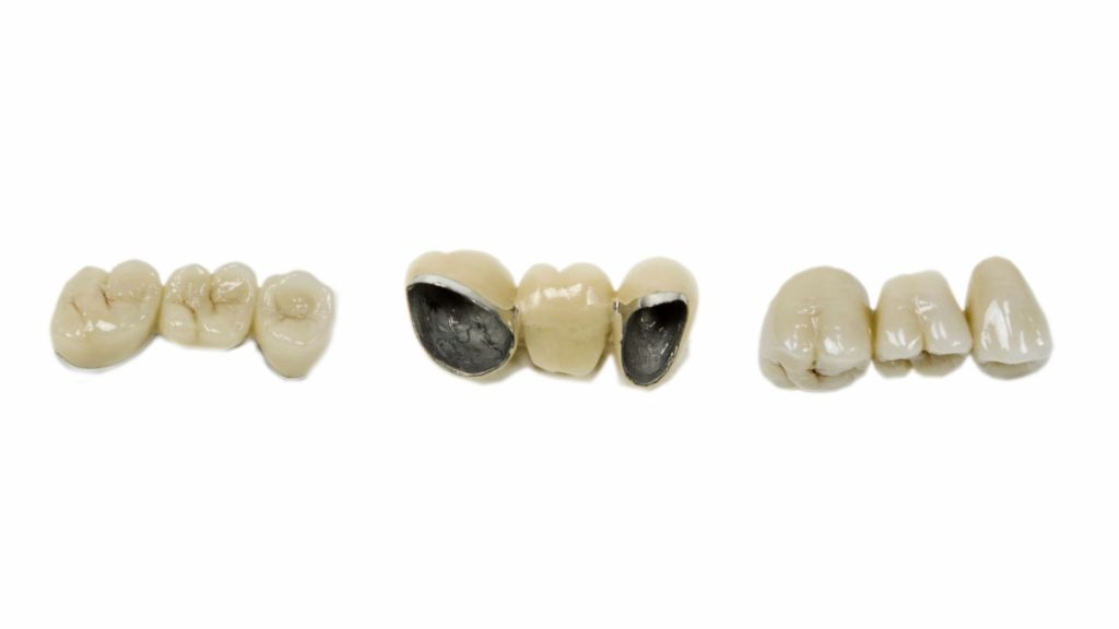 dental bridge dental bridge