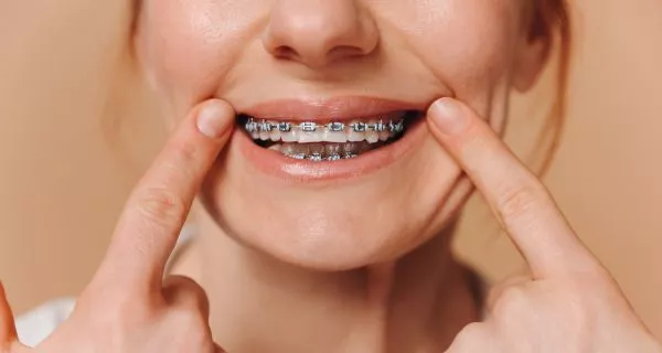 Benefits of Orthodontic Treatment with Braces