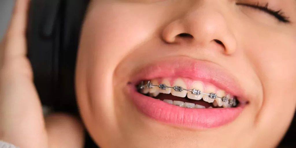 Braces in Santa Paula: Orthodontic Care for the Whole Family