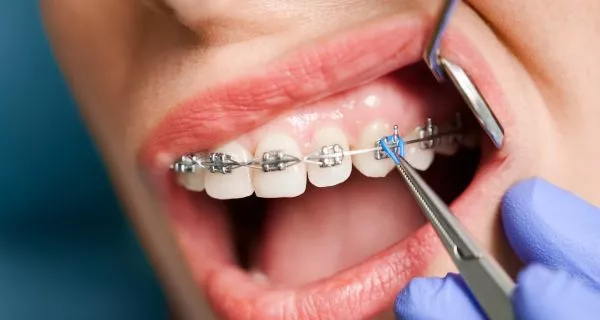 Types of Braces Available in Santa Paula