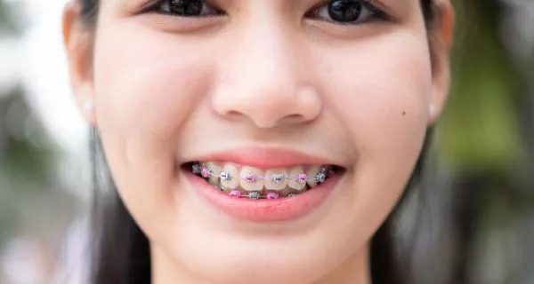 What Are Dental Braces and How Do They Work