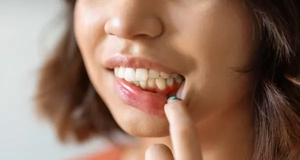 Gum irritation and soft tissue damage