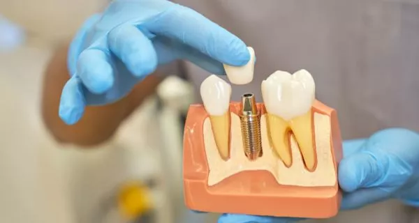 What are dental implants?