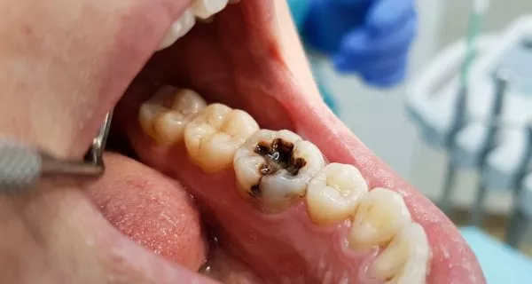 What causes a severe toothache