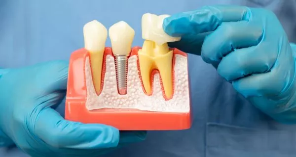 What is a dental crown?
