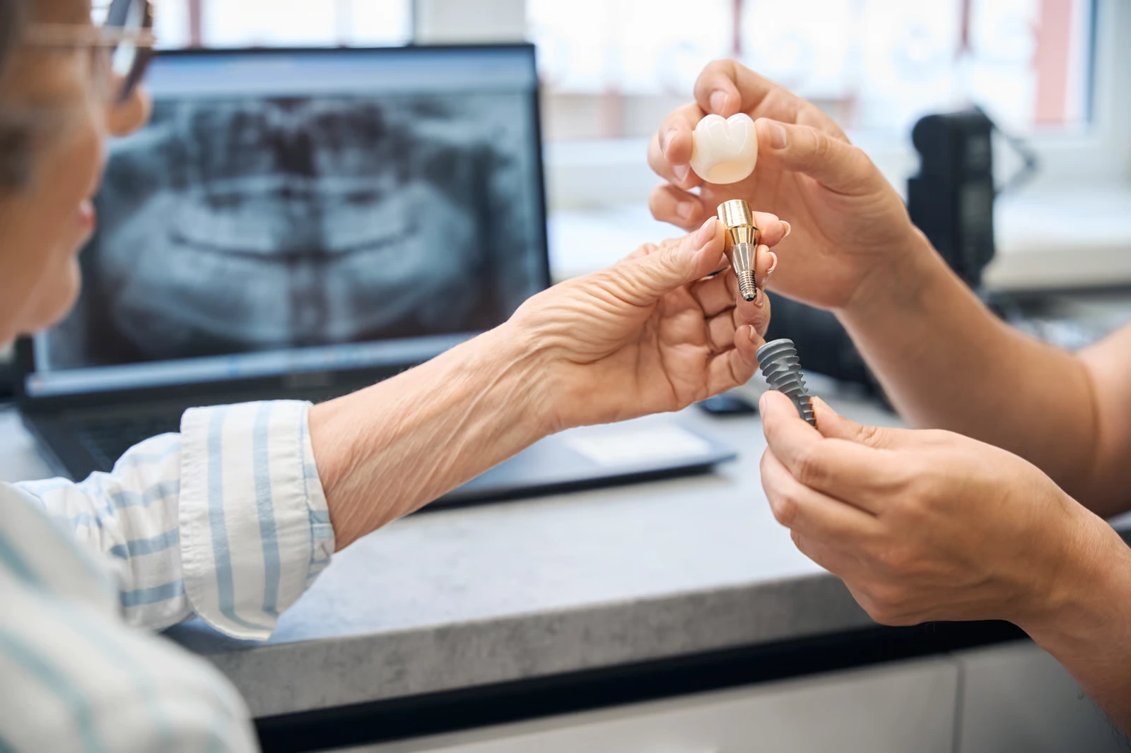 Implantes Dentales en Santa Paula